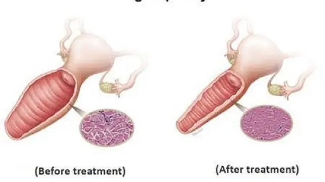 Vaginoplasty