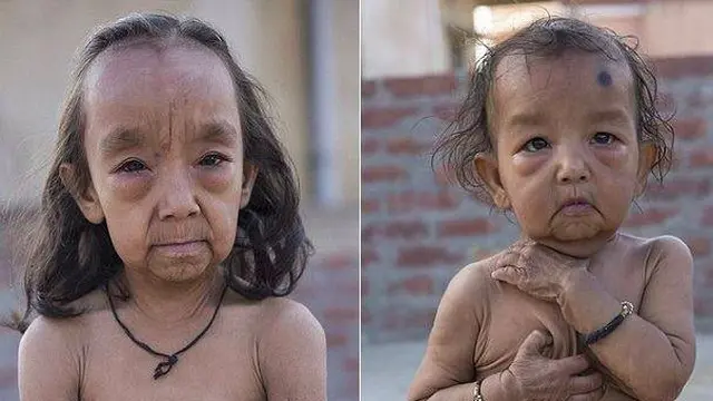 kakak adik alami kelainan kulit