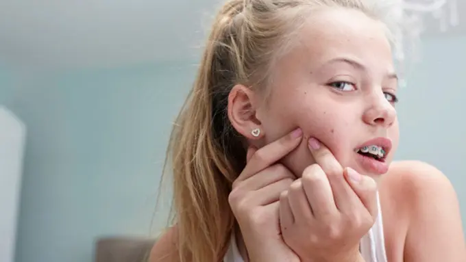 7 Hal yang Bisa Bikin Jerawatmu Tambah Parah