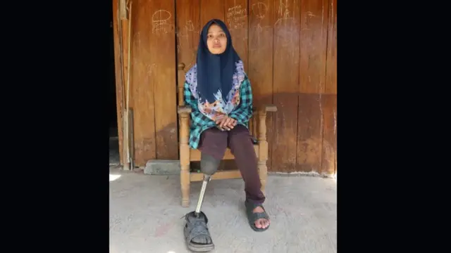 Kisah Yubita Hida, Mahasiswi Disabilitas di Yogyakarta yang Akhirnya Punya Kaki Palsu dengan Desain Lebih Humanis.  Foto: UGM.