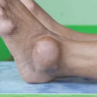 Minuman herbal alami seperti jus ceri, rebusan jahe, dan campuran kunyit dipercaya membantu menurunkan asam urat. Temukan resep dan panduan lengkap untuk mengatasi asam urat secara alami di sini.