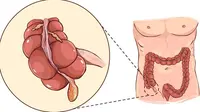 Ilustrasi usus buntu