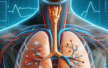 Kasus Pneumonia Misterius Terdeteksi di Indonesia, Begini Imbuan Kemenkes Kepada Masyarakat