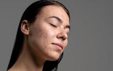 Bukan Pakai Banyak Skincare, Ini Cara Cepat Mengatasi Jerawat Tanpa Iritasi dan Minimal Bahan Aktif