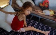 FOTO: Nestapa Gadis 5 Tahun di Jalur Gaza Menderita Kekurangan Gizi Imbas Perang, Beratnya Kini Hanya 9 Kg