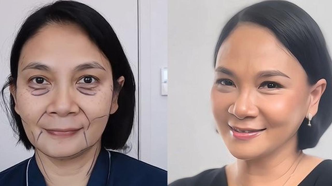 Potret Wajah Dian Nitami Sebulan Pasca Face Lifting: Kulit Kencang dan Hasil Natural