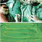 Cacing pita babi yang dikeluarkan dari usus seorang pria. (Live Science)