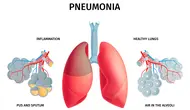 Ilustrasi pneumonia. (Image by macrovector on Freepik)