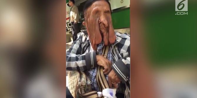 VIDEO: Wajah Nenek Ini 'Meleleh' karena Penyakit Langka