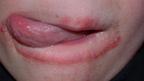 Apa Yang Sebabkan Kulit Di Sudut Bibir Kering Health Liputan6 Com