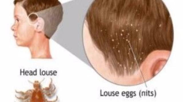 Cara Menghilangkan Kutu Rambut dan Telur Kutu Secara Alami dan Permanen -  Health Liputan6.com