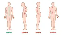 Kelainan Tulang Skoliosis, Kifosis, dan Lordosis (sumber: istock)