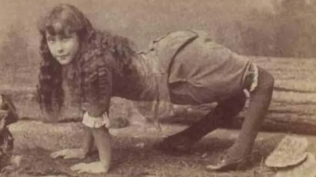 Terlahir Dengan Kondisi Langka, 5 Orang Ini Menjadi Tontonan Sirkus Di Masa Lalu