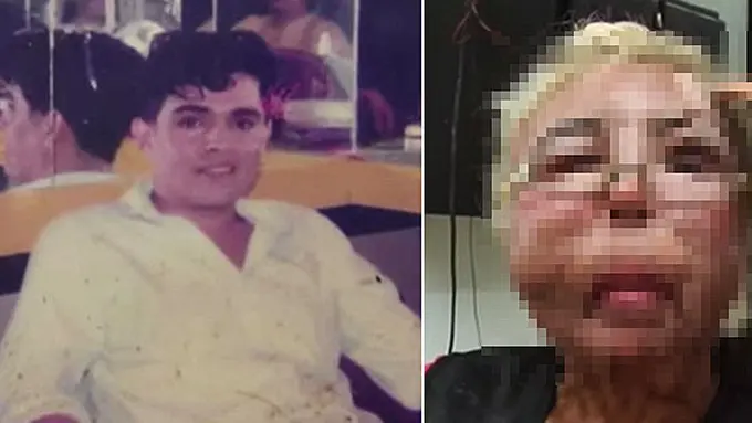 Foto sebelum dan sesudah suntikan | Copyright: stomp.com