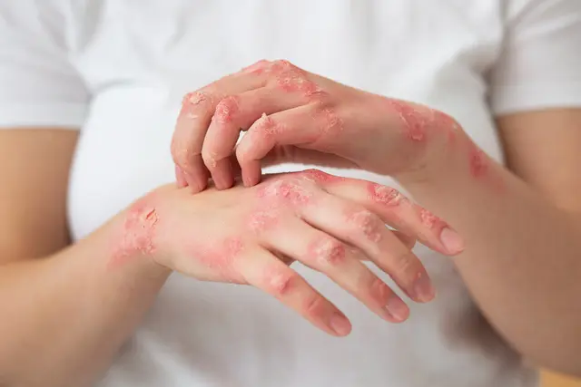 Apakah ke Dokter Kulit Bisa Pakai BPJS?