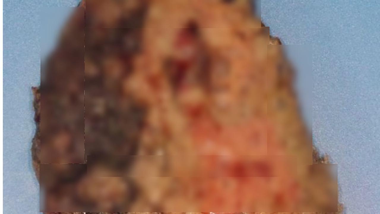 Seram, Penampakan Paru-Paru Wanita Muda yang Rusak Akibat Virus Corona