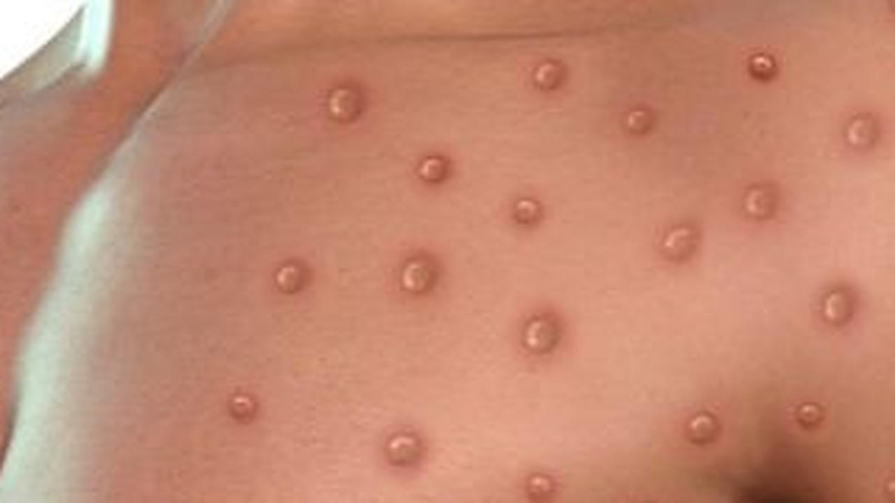 Satu Warga Suspek Monkeypox, Dinkes Sumsel Pastikan Hanya Cacar Biasa