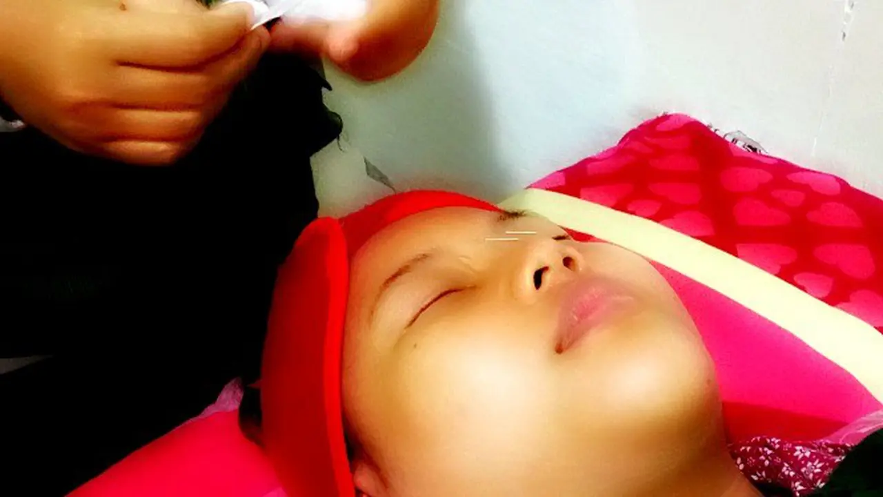 Akupunktur Kecantikan Bikin Wajah Bersinar