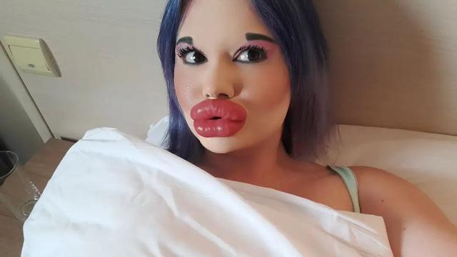 Ingin Tampil Bak Boneka, Wanita Akan Injeksi Bibir Ke 27 Kali Akhir Tahun Ini