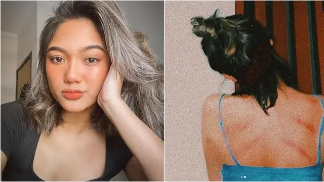 7 Potret Seleb Cantik Pamer Usai Kerokan Ini Tetap Menawan