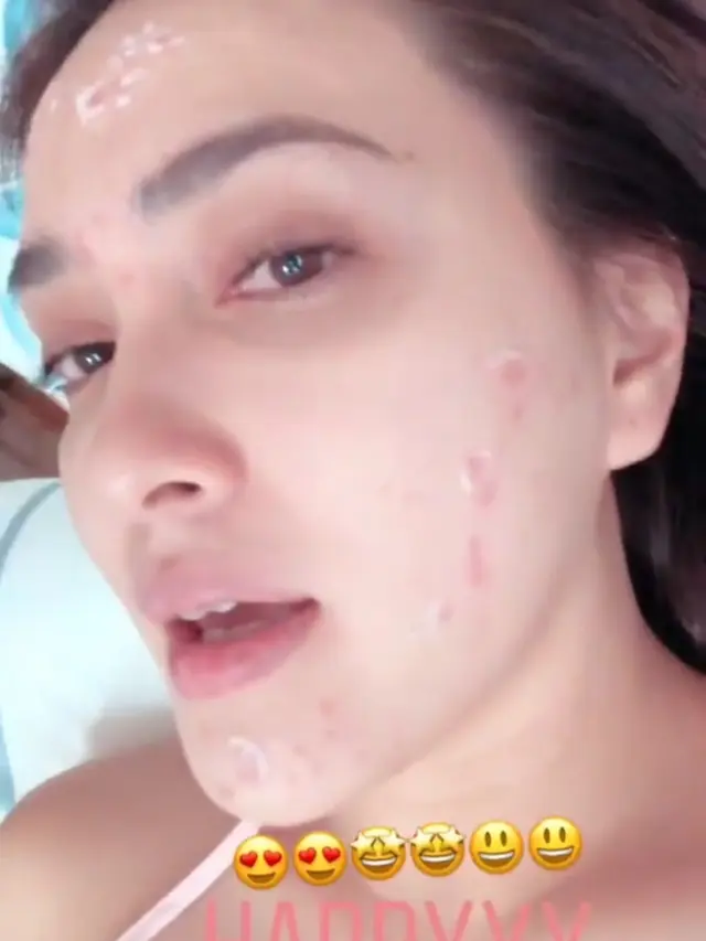 7 Potret Selebriti Wanita Saat Pamer Wajah Berjerawat Ini Tetap Memesona