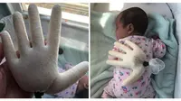 Wanita ini Membuat Tangan Palsu Buat Anaknya, Alasannya Bikin Haru