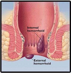 internal-external-hemorrhoids