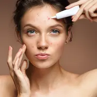 ilustrasi obat jerawat/shutterstock