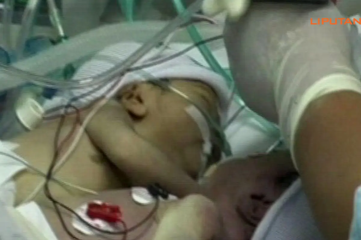 bayi-kembar-siam--130814b.jpg