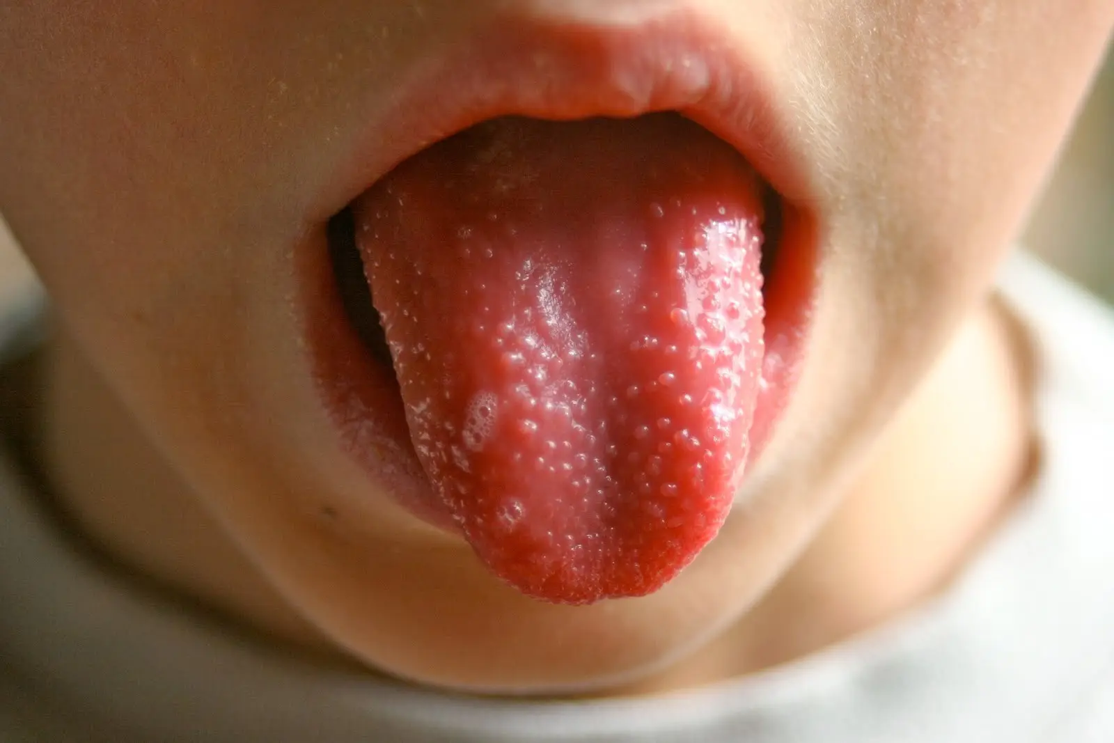 Jangan diabaikan, ini ciri-ciri kanker lidah yang sering disepelekan. (Sumber Foto: dailyhealthtips.co)