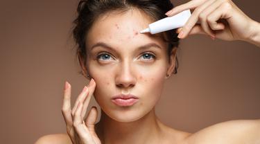 Yang Benar Acne Prone Itu Masalah Kulit Bukan Jenis Kulit Beauty Fimela Com