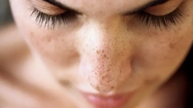 Hilangkan flek hitam di pipi