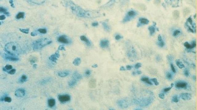 Bakteri Pemakan Daging