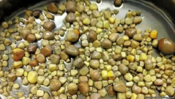 Dokter di Cina Keluarkan Ratusan Batu dari Ginjal Seorang Pria