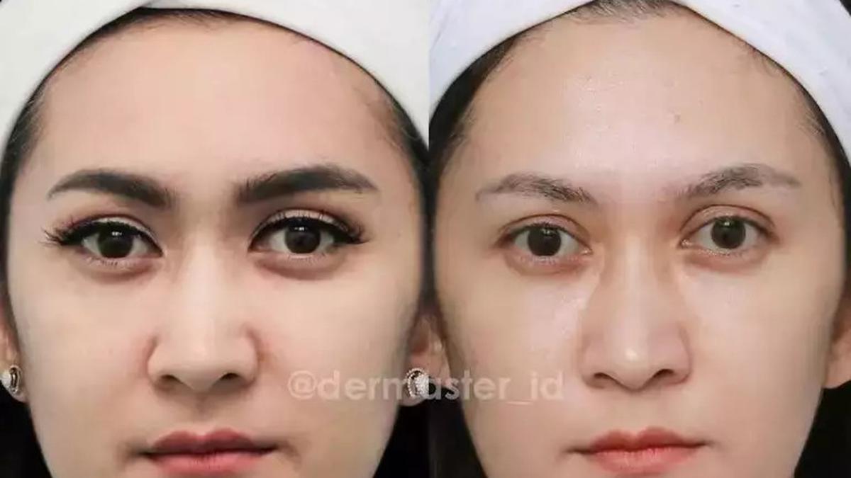 Transformation Mengagumkan! 10 Potret Selebriti Sebelum dan Setelah Tanam Benang yang Bikin Pangling