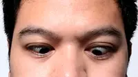 9 Gejala Mata Juling alias Strabismus, Apa Penyebab dan Bagaimana Cara Menanganinya?