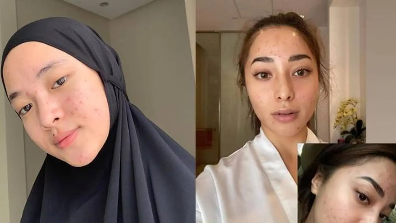 7 Potret Selebriti Wanita Saat Pamer Wajah Berjerawat Ini Tetap Memesona