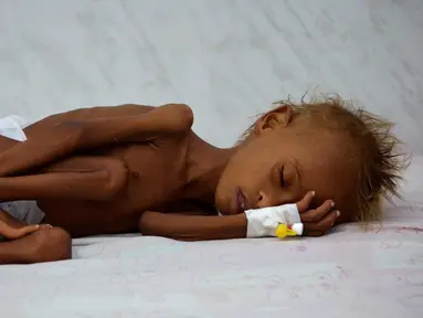 Seorang anak tergeletak di tempat tidur di unit malnutrisi perawatan intensif di sebuah rumah sakit di kota pelabuhan Laut Merah dari Hodaida, Yaman pada 11 September 2016. (REUTERS/Khaled Abdullah)
