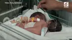 Bayi kembar siam dempet lahir di Bali dari pasangan Syamsudin dan Asini.