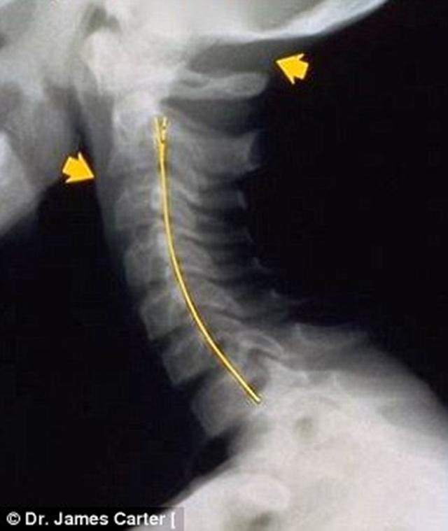 Tulang leher yang terganggu karena kebanyakan main ponsel | Photo: Copyright dailymail.co.uk