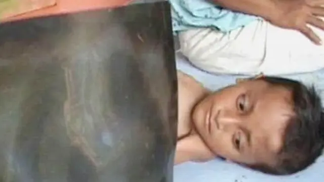 Bocah Korban Gizi Buruk Butuh Bantuan