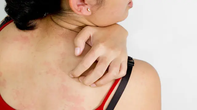 Dampak Kurang Tidur Bagi Kecantikan Kulit