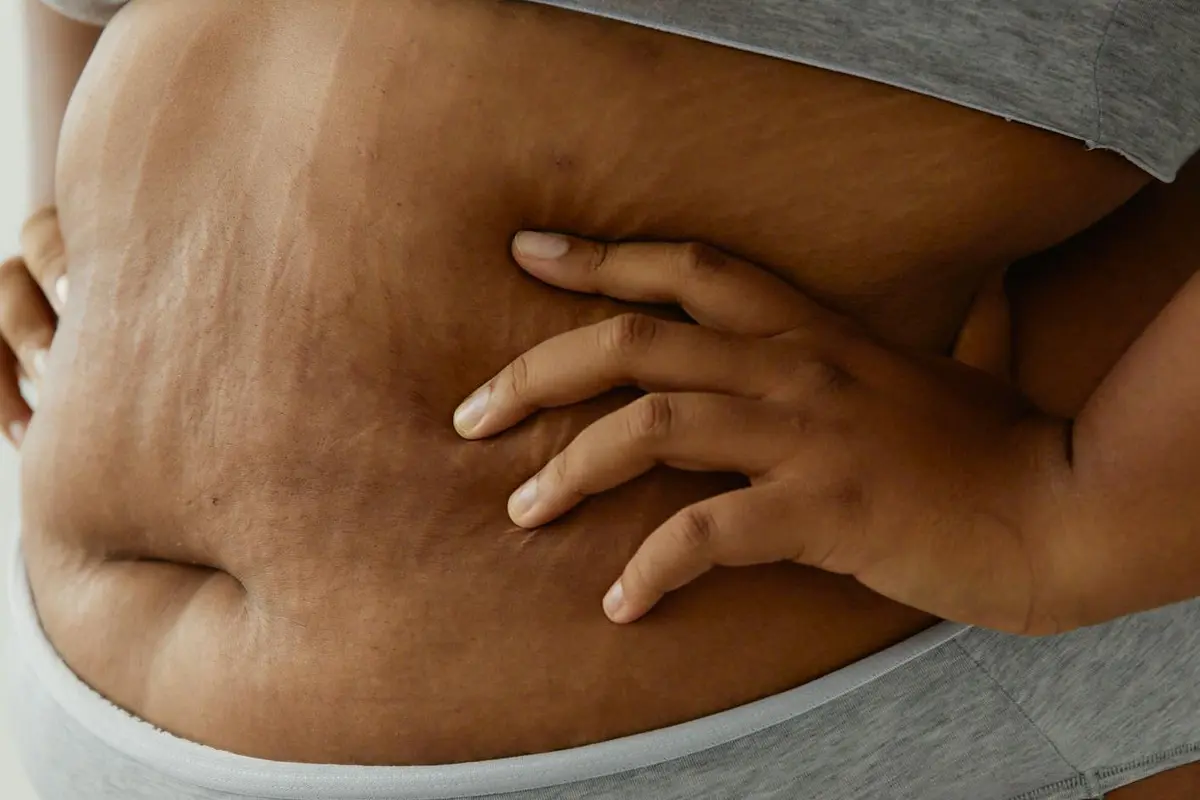 Berbadan gemuk memiliki stretch mark di perutnya