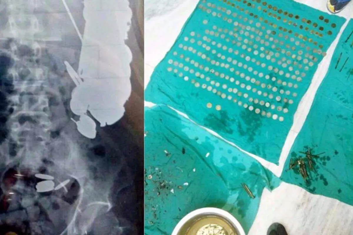 Dokter Temukan 263 Koin dan 100 Paku di Perut Pria Ini, Santet?