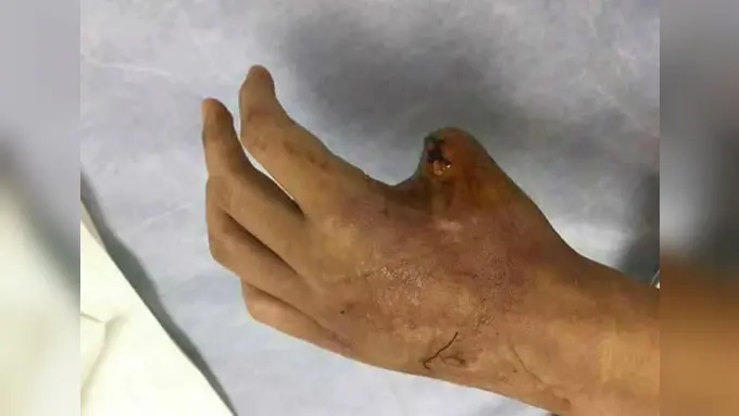 Bentuk jari korban setelah digigit ular (Facebook/Fakultas Kedokteran Hewan New York) 