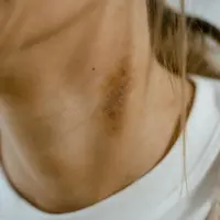 Cara Menghilangkan Bekas Luka Bakar Tanpa Ribet