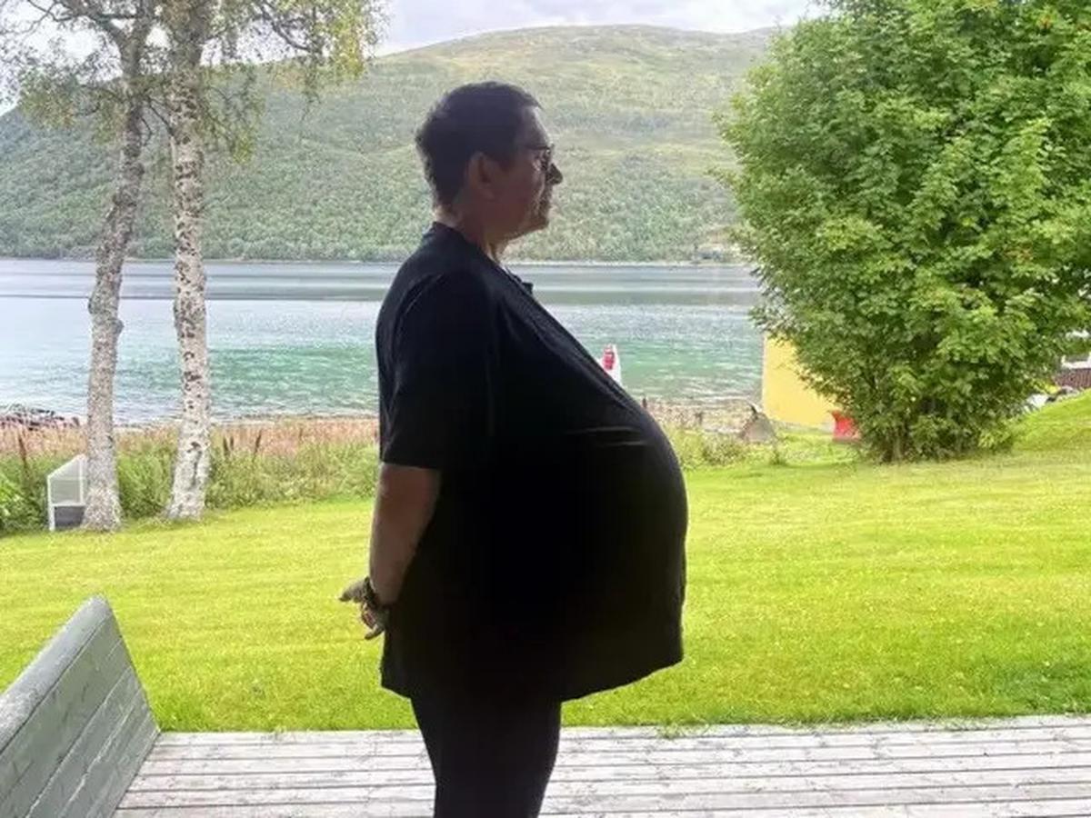 Dicap Gemuk, Pria Ini Ternyata Punya Tumor Seberat 27 Kg di Perut