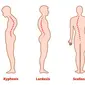 Kelainan Tulang Skoliosis, Kifosis, dan Lordosis (sumber: istock)