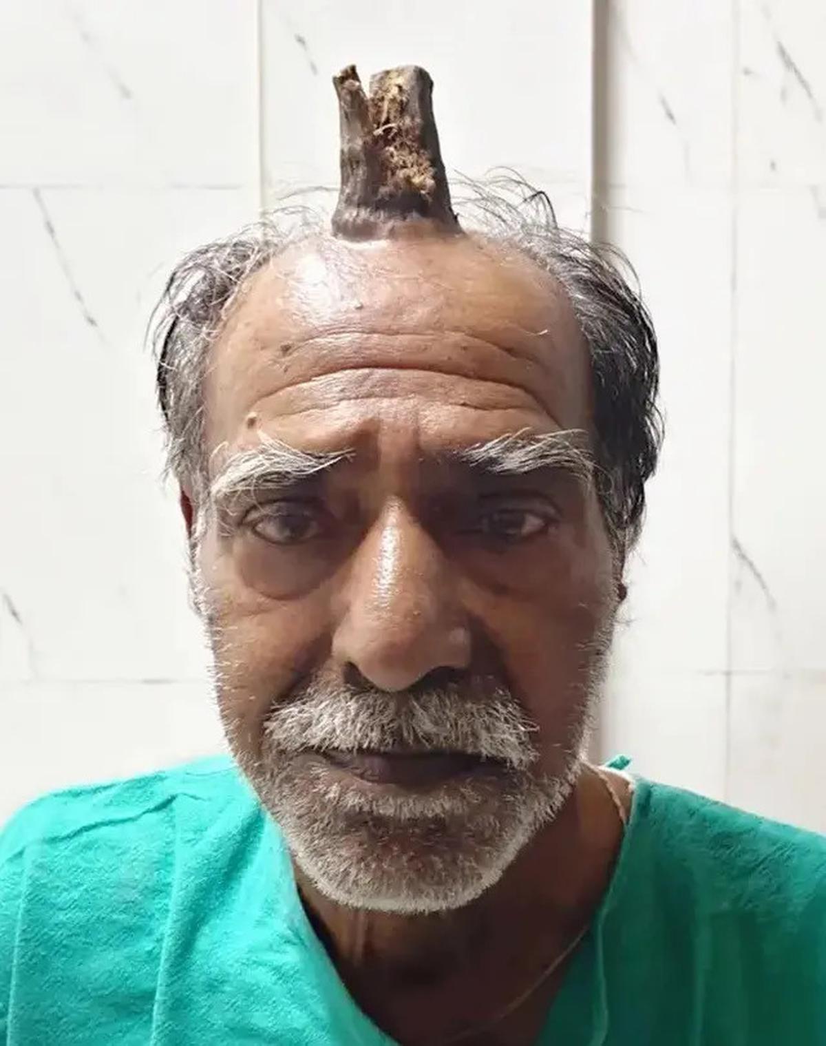 Viral Dahi Nenek 107 Tahun Ini Tumbuh Tanduk, Disebut Bikin Panjang Umur