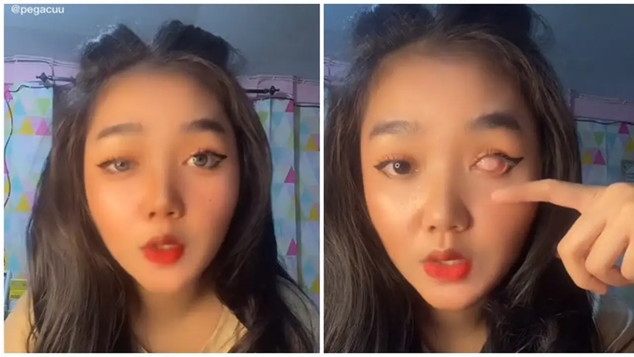 Mata Ditutupi Selaput, Kisah Wanita Pakai Mata Palsu Seumur Hidup Ini Bikin Haru